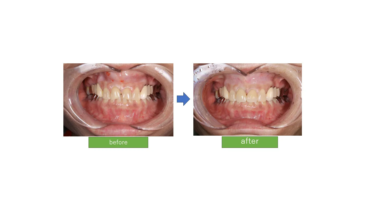 前歯を綺麗にしたい(ジルコニアセラミック)：上永谷駅小泉歯科