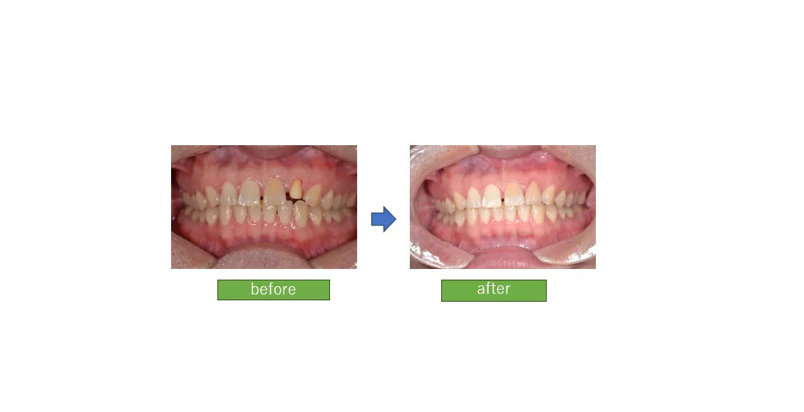 自然なセラミック治療症例：上永谷徒歩４分小泉歯科医院