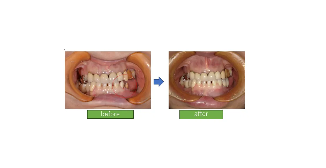 ブリッジで奥歯を回復(セラミック治療)：上永谷小泉歯科医院