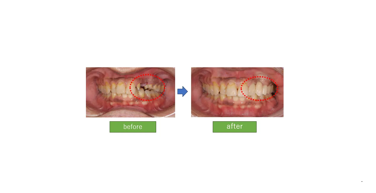 ジルコニアセラミックブリッジ治療(４０代男性)