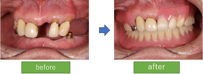 安定した義歯(インプラントオーバーデンチャー)