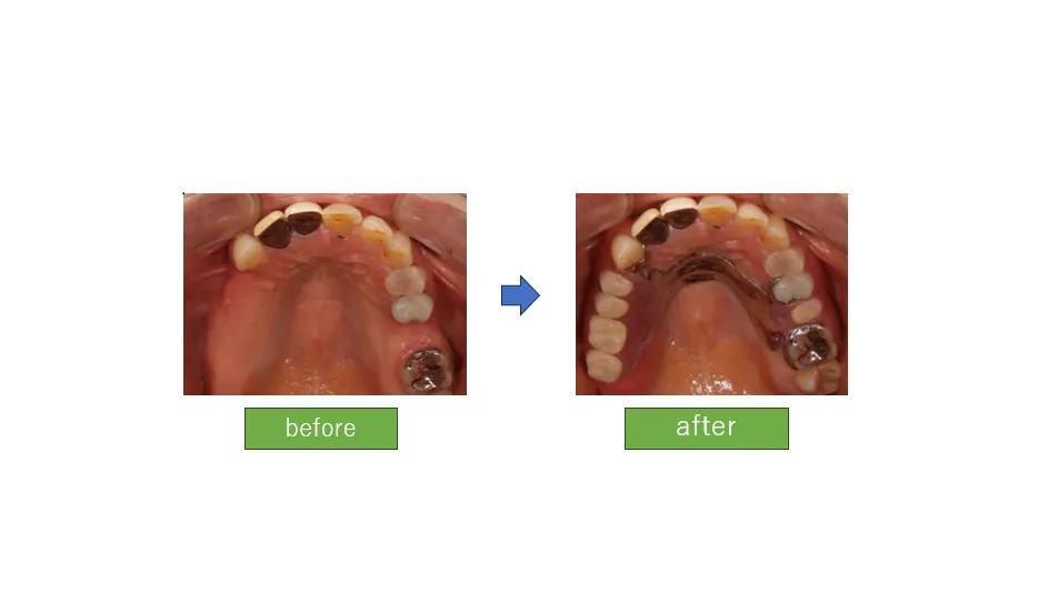 義歯によるスムーズな会話を実現