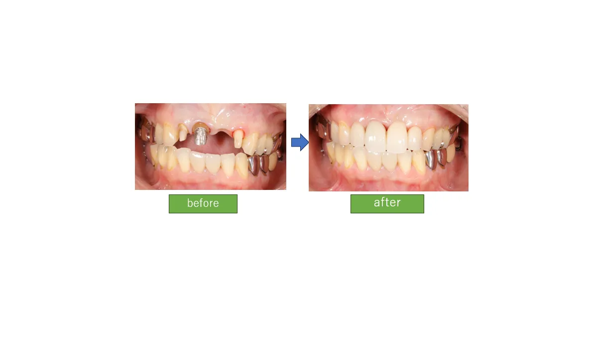 白くて綺麗な歯をいれたい(ジルコニアセラミック) 40代女性