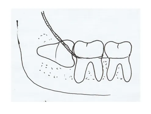 困ってないけど親知らずは抜いたほうがいいの?(抜歯したほうがよいタイプ紹介)